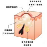 控油祛痘的馨漫之舍来了，简简单单的祛痘产品